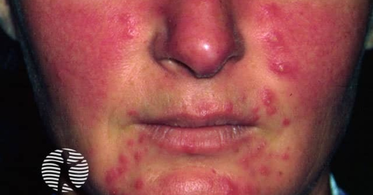 Rosacea image