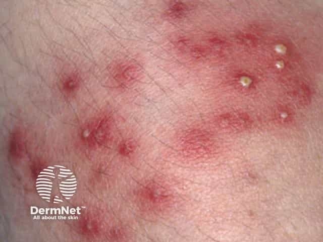 Folliculitis Face Rash Folliculitis Face Rash