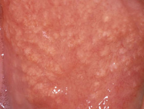 What is sebaceous prominence