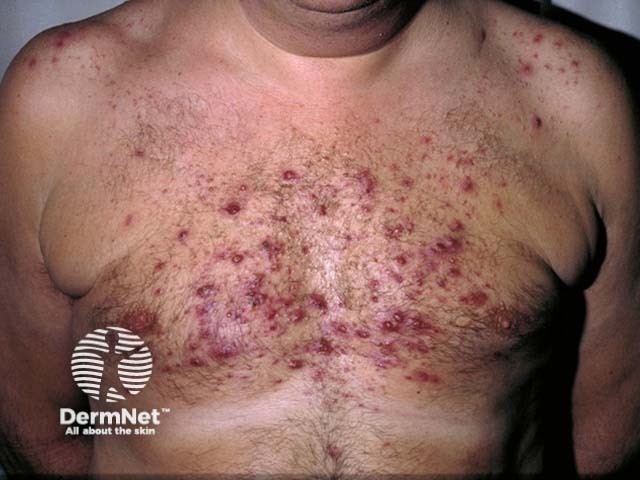 Steroid-induced acne vulgaris