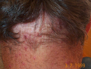 folliculitis scalp cure