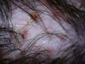 folliculitis scalp