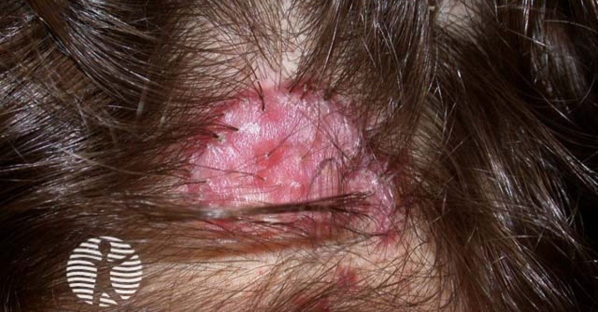 DermNet® - Scalp folliculitis image