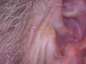 Sebaceous hyperplasia