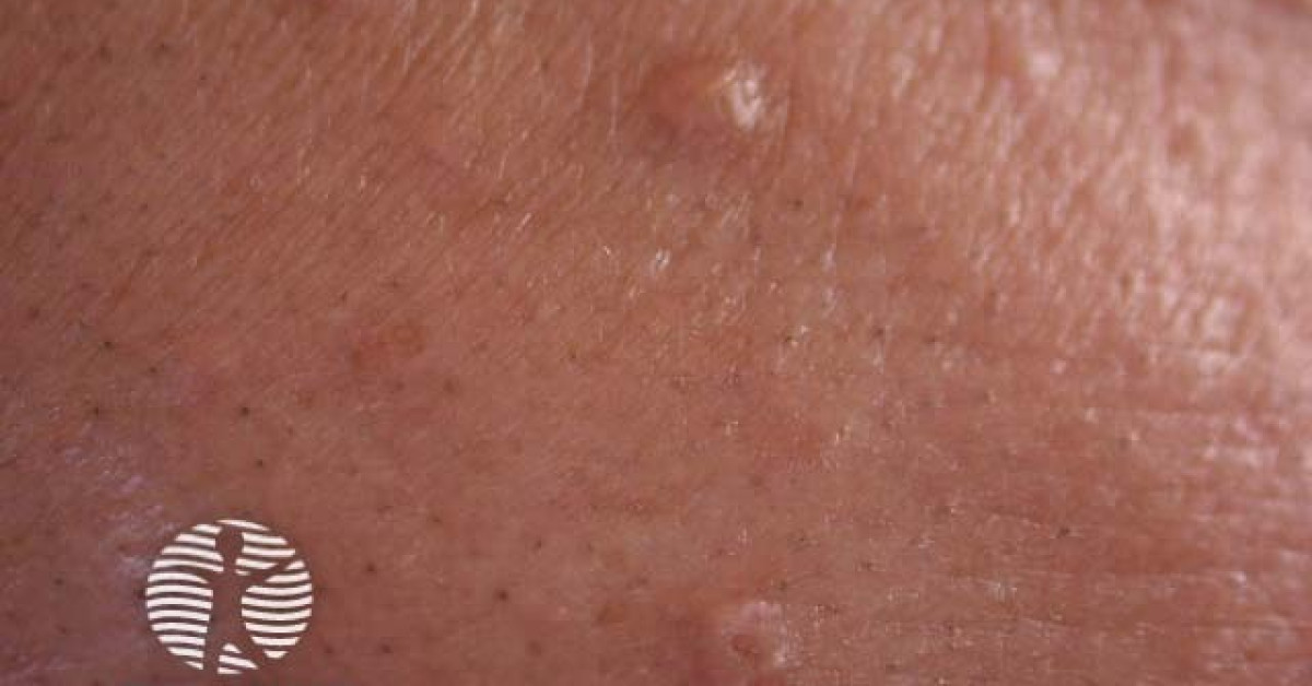 Sebaceous hyperplasia image