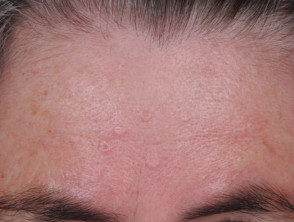 Prominence what is sebaceous Sebaceous Prominence