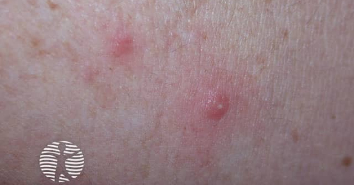 Spa pool folliculitis image