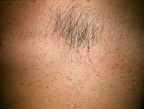 steroid acne1 s