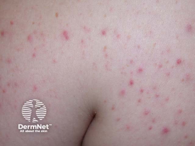 Steroid acne