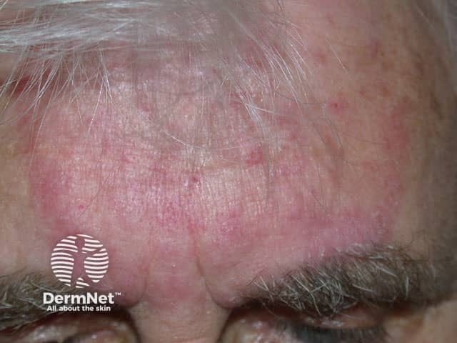 Tinea faciei treated with topical steroid