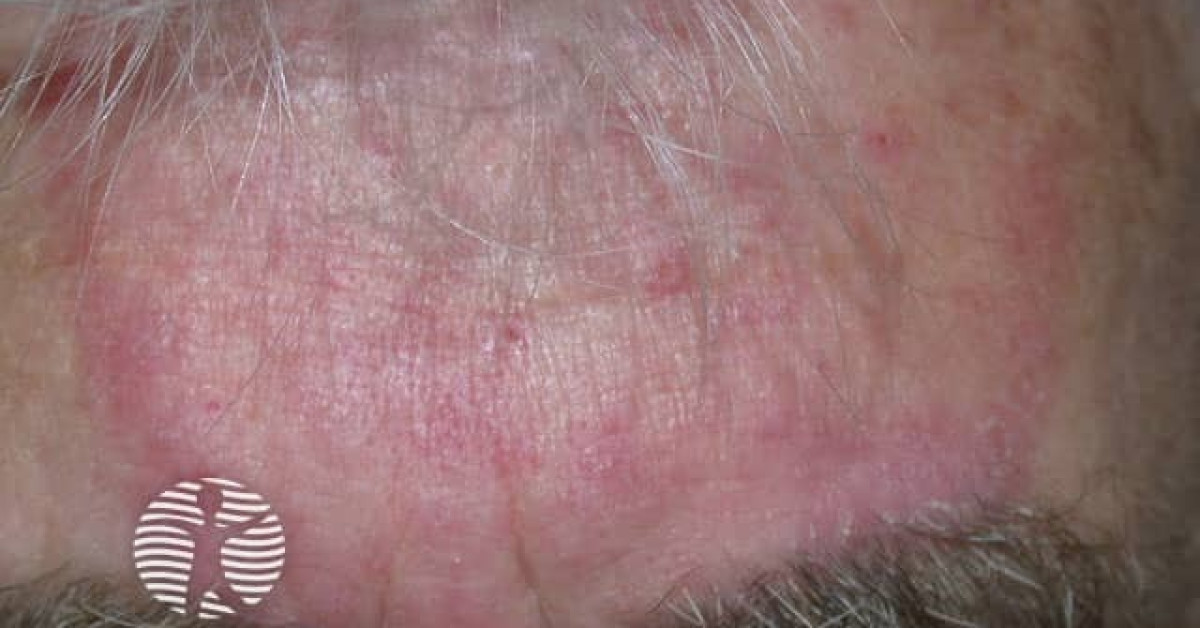 DermNet® - Tinea faciei image