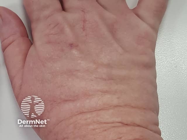 Acral persistent papular mucinosis