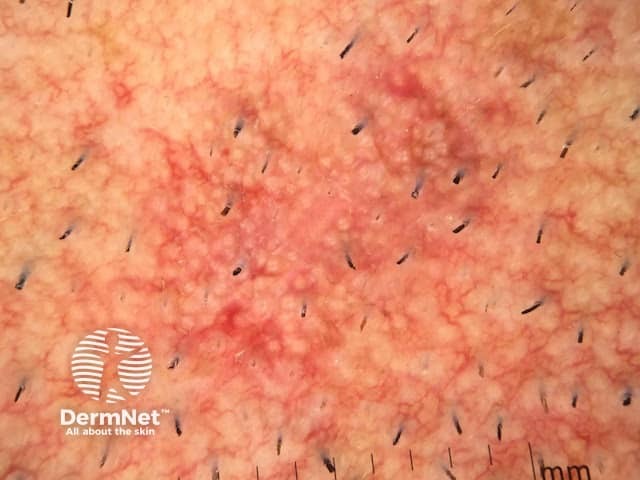 Dermoscopy of actinic keratosis on the face