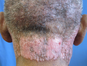 Actinic reticuloid - severe chronic photosensitivity dermatitis