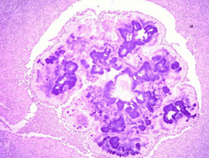 H&E stain of actinomycosis grains