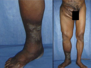 Actinomycetoma foot and legs
