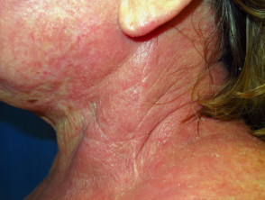 Acute eczema