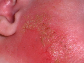 Acute eczema
