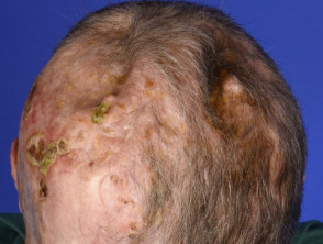 Scarring from surgeries to many basal cell carcinomas in basal cell naevus syndrome