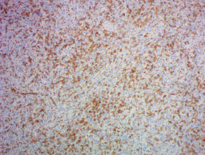 Angioimmunoblastic T-cell lymphoma pathology using PD1 staining x 100