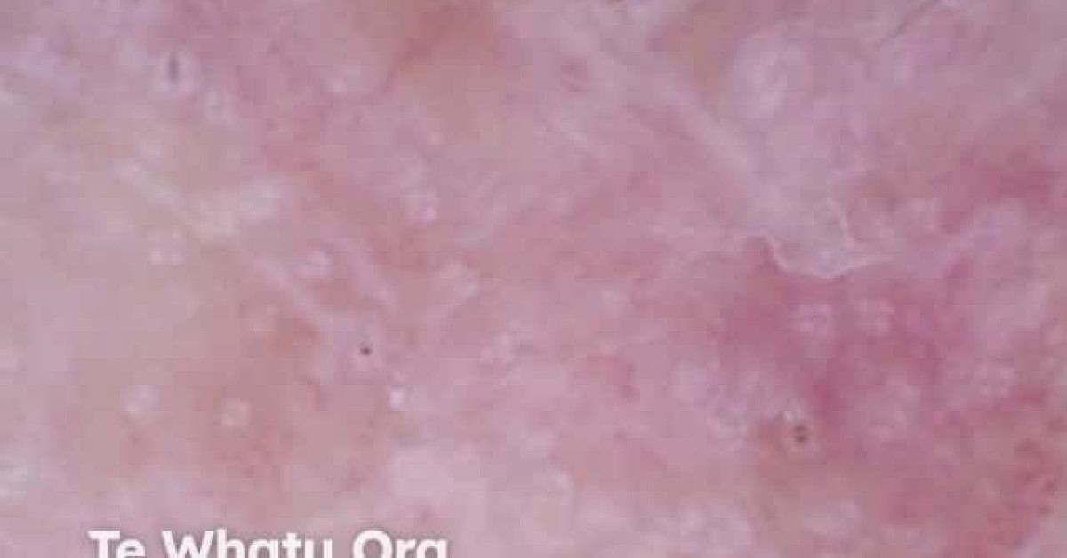 Rosettes in actinic keratosis image