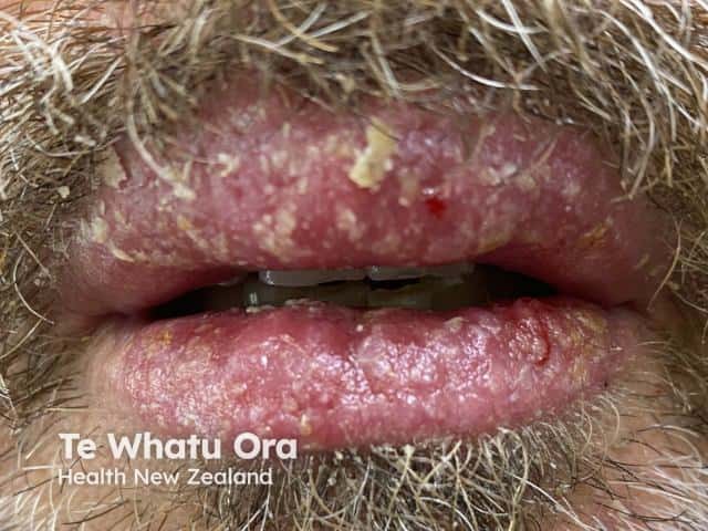 Eczema of the lips due to propyl gallate allergy in a lip salve