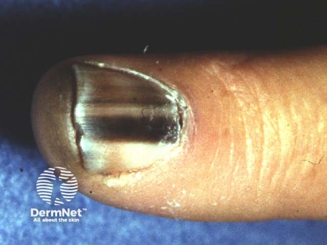 Irregular pigmented longitudinal bands in melanoma of the nail unit