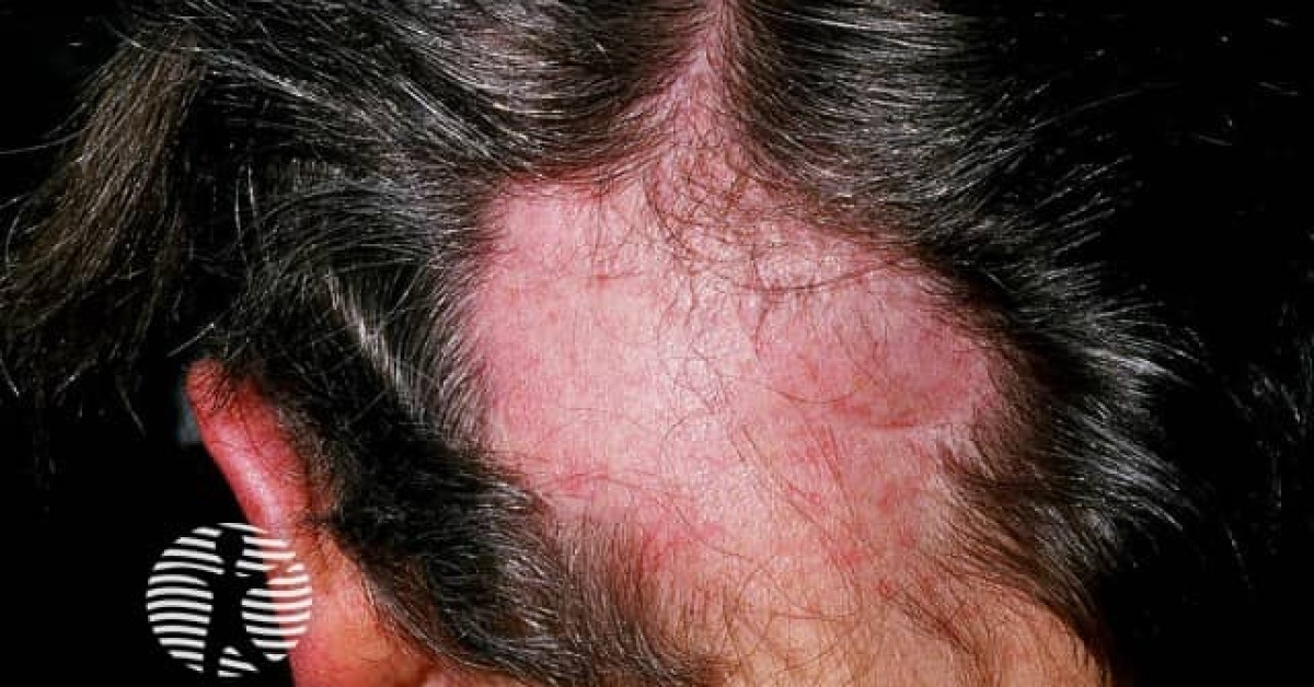 DermNet® - Alopecia areata image