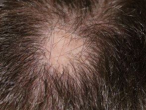 Alopecia areata in a patient on antiTNF