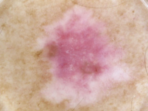 Amelanotic lentigo maligna melanoma
