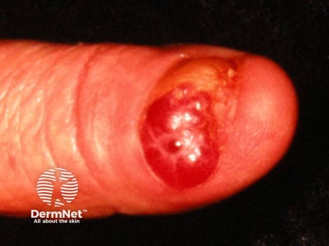 Amelanotic subungal melanoma - a red lesion arising from the nail fold that has produced destruction of the nail plate