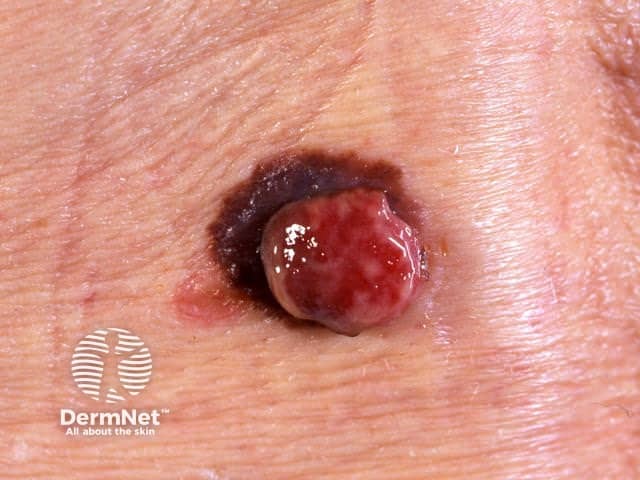 Amelanotic melanoma arising within pigmented melanoma
