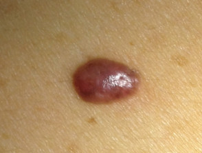 Amelanotic melanoma