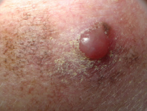 Amelanotic melanoma