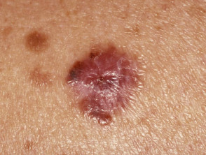 amelanotic melanoma 17 of 125