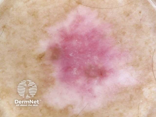 Superficial spreading melanoma in situ