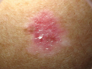 Amelanotic superficial spreading melanoma in situ