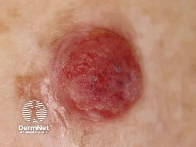 Amelanotic melanoma 3mm