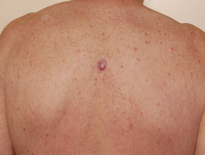 Amelanotic melanoma on the back