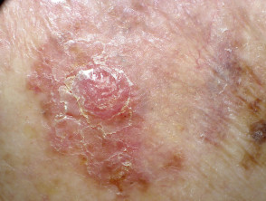 Amelanotic melanoma on the back
