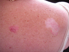 Amelanotic melanoma on left