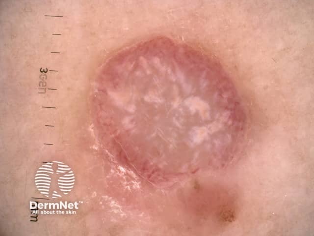 Dermoscopic image of amelanotic melanoma 1