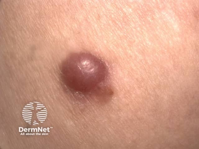 Macro image of amelanotic melanoma 1