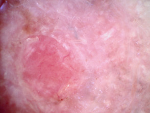 Amelanotic melanoma dermoscopy