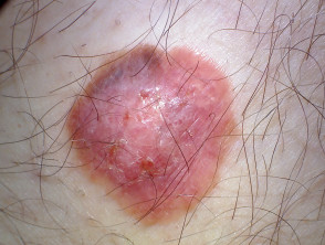 Amelanotic melanoma macro