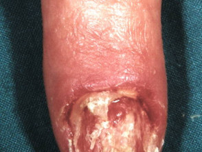 Amelanotic melanoma of the nail unit