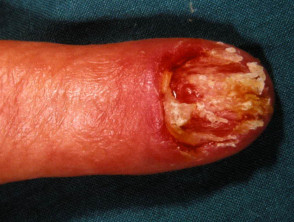 Amelanotic nail melanoma