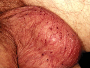 Head spots on little of penis red Red Spots
