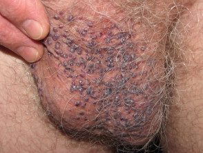 Angiokeratoma of Fordyce on scrotum
