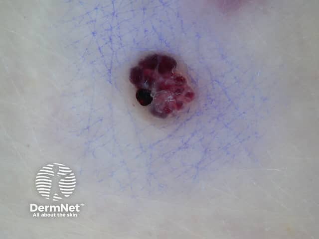 Dermoscopy of angiokeratoma of Fordyce on vulva
